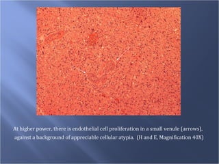 At higher power, there is endothelial cell proliferation in a small venule (arrows), against a background of appreciable cellular atypia.  (H and E, Magnification 40X) 