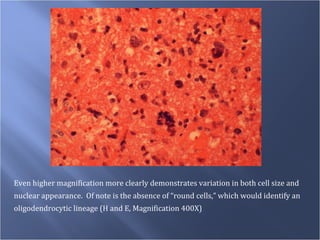 Even higher magnification more clearly demonstrates variation in both cell size and  nuclear appearance.  Of note is the absence of “round cells,” which would identify an  oligodendrocytic lineage (H and E, Magnification 400X) 
