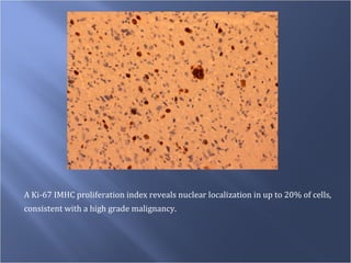 A Ki-67 IMHC proliferation index reveals nuclear localization in up to 20% of cells,  consistent with a high grade malignancy. 