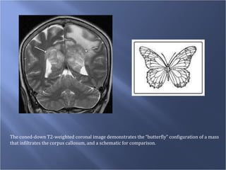 The coned-down T2-weighted coronal image demonstrates the “butterfly” configuration of a mass  that infiltrates the corpus callosum, and a schematic for comparison.  