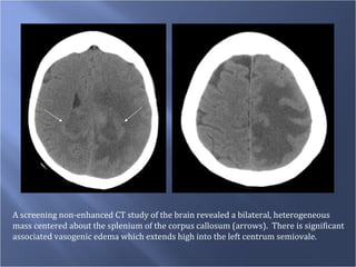 A screening non-enhanced CT study of the brain revealed a bilateral, heterogeneous  mass centered about the splenium of the corpus callosum (arrows).  There is significant  associated vasogenic edema which extends high into the left centrum semiovale. 