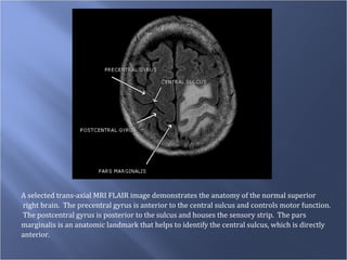 A selected trans-axial MRI FLAIR image demonstrates the anatomy of the normal superior right brain.  The precentral gyrus is anterior to the central sulcus and controls motor function.  The postcentral gyrus is posterior to the sulcus and houses the sensory strip.  The pars  marginalis is an anatomic landmark that helps to identify the central sulcus, which is directly  anterior. 