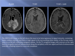 FLAIR T1WI T1WI + GAD The MRI FLAIR image on the left shows the mass to be heterogeneous in signal intensity, containing water content centrally and there is high signal in the surrounding white matter of the forceps major, more so on the left, reflecting vasogenic edema.  On the T1-weighted image with contrast on the right, there is irregular contrast enhancement along the periphery with low signal and lack of enhancement centrally, a finding related to a necrotic neoplasm. 