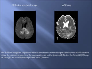Diffusion weighted image ADC map The diffusion-weighted sequence detects a few areas of increased signal intensity restricted diffusion along the peripheral aspects of the mass, confirmed by the Apparent Diffusion Coefficient (ADC) map  on the right with corresponding darker areas (arrows).  
