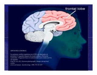 HIPOXEMIA CEREBRAL
Los primeros cambios isquémicos en el EEG son detectados en
promedio 6.5 segundos después de un paro cardiaco (fibrilación
ventricular). Progresión hacia la isoelectricidad ocurre dentro de 10 a
20 segundos.
Clute H, Levy WJ. Eletroencephalographic changes during brief
cardiac
arrest um humans. Anesthesiology. 1990; 73: 821-825
 