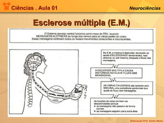 Ciências . Aula 01 Neurociências   Esclerose múltipla (E.M.) 