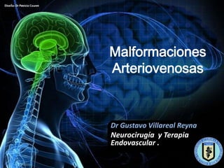 Malformaciones
Arteriovenosas



Dr Gustavo Villareal Reyna
Neurocirugía y Terapia
Endovascular .
 