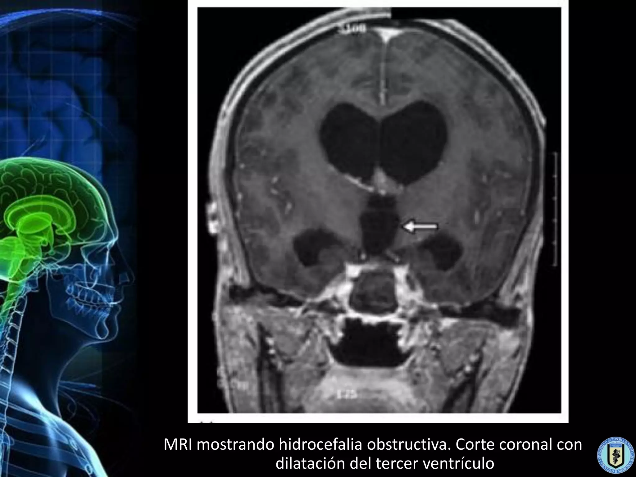 MRI mostrando hidrocefalia obstructiva. Corte coronal con
             dilatación del tercer ventrículo
 