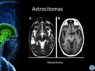 Astrocitomas




     Astrocitoma
 