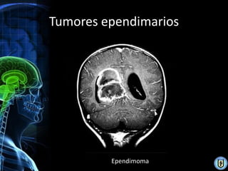 Tumores ependimarios




         Ependimoma
 