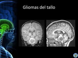 Gliomas del tallo
 