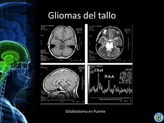 Gliomas del tallo




    Glioblastoma en Puente
 