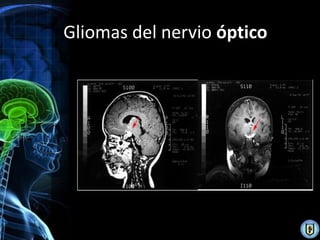 Gliomas del nervio óptico
 