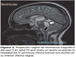Ventricular
Ocasiona hidrocefalia
 