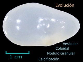 Vesicular
Coloidal
Evolución
Nódulo Granular
Calcificación
 