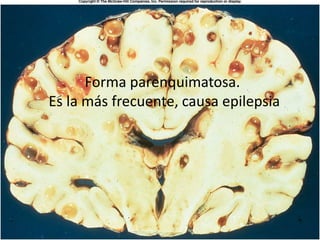 Forma parenquimatosa.
Es la más frecuente, causa epilepsia
 