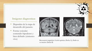 Imágenes diagnosticas
• Dependen de la etapa de
desarrollo del parasito
• Forma vesicular:
contenido hipodenso y
bien definido (cisticerco
vivo) Resonancia magnética: Lesión quística (flecha A), fluido en
su interior (flecha B)
 