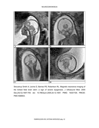 NEUROCONFERENCIA
EMBRIOLOGÍA DEL SISTEMA NERVIOSO pág. 12
Stroustrup Smith A, Levine D, Barnes PD, Robertson RL. Magnetic resonance imaging of
the kinked fetal brain stem: a sign of severe dysgenesis. J Ultrasound Med. 2005
Dec;24(12):1697-709. doi: 10.7863/jum.2005.24.12.1697. PMID: 16301726; PMCID:
PMC1698953.
 