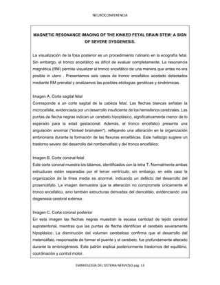 NEUROCONFERENCIA
EMBRIOLOGÍA DEL SISTEMA NERVIOSO pág. 13
MAGNETIC RESONANCE IMAGING OF THE KINKED FETAL BRAIN STEM: A SIGN
OF SEVERE DYSGENESIS.
La visualización de la fosa posterior es un procedimiento rutinario en la ecografía fetal.
Sin embargo, el tronco encefálico es difícil de evaluar completamente. La resonancia
magnética (RM) permite visualizar el tronco encefálico de una manera que antes no era
posible in utero . Presentamos seis casos de tronco encefálico acodado detectados
mediante RM prenatal y analizamos las posibles etiologías genéticas y sindrómicas.
Imagen A. Corte sagital fetal
Corresponde a un corte sagital de la cabeza fetal. Las flechas blancas señalan la
microcefalia, evidenciada por un desarrollo insuficiente de los hemisferios cerebrales. Las
puntas de flecha negras indican un cerebelo hipoplásico, significativamente menor de lo
esperado para la edad gestacional. Además, el tronco encefálico presenta una
angulación anormal ("kinked brainstem"), reflejando una alteración en la organización
embrionaria durante la formación de las flexuras encefálicas. Este hallazgo sugiere un
trastorno severo del desarrollo del rombencéfalo y del tronco encefálico.
Imagen B. Corte coronal fetal
Este corte coronal muestra los tálamos, identificados con la letra T. Normalmente ambas
estructuras están separadas por el tercer ventrículo; sin embargo, en este caso la
organización de la línea media es anormal, indicando un defecto del desarrollo del
prosencéfalo. La imagen demuestra que la alteración no compromete únicamente el
tronco encefálico, sino también estructuras derivadas del diencéfalo, evidenciando una
disgenesia cerebral extensa.
Imagen C. Corte coronal posterior
En esta imagen las flechas negras muestran la escasa cantidad de tejido cerebral
supratentorial, mientras que las puntas de flecha identifican el cerebelo severamente
hipoplásico. La disminución del volumen cerebeloso confirma que el desarrollo del
metencéfalo, responsable de formar el puente y el cerebelo, fue profundamente alterado
durante la embriogénesis. Este patrón explica posteriormente trastornos del equilibrio,
coordinación y control motor.
 