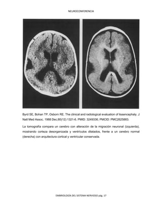 NEUROCONFERENCIA
EMBRIOLOGÍA DEL SISTEMA NERVIOSO pág. 17
Byrd SE, Bohan TP, Osborn RE. The clinical and radiological evaluation of lissencephaly. J
Natl Med Assoc. 1988 Dec;80(12):1321-6. PMID: 3249336; PMCID: PMC2625883.
La tomografía compara un cerebro con alteración de la migración neuronal (izquierda),
mostrando corteza desorganizada y ventrículos dilatados, frente a un cerebro normal
(derecha) con arquitectura cortical y ventricular conservada.
 