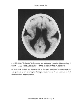 NEUROCONFERENCIA
EMBRIOLOGÍA DEL SISTEMA NERVIOSO pág. 18
Byrd SE, Bohan TP, Osborn RE. The clinical and radiological evaluation of lissencephaly. J
Natl Med Assoc. 1988 Dec;80(12):1321-6. PMID: 3249336; PMCID: PMC2625883.
La tomografía muestra una alteración de la migración neuronal con corteza cerebral
desorganizada y ventriculomegalia, hallazgos característicos de un desarrollo cortical
anormal durante la embriogénesis.
 