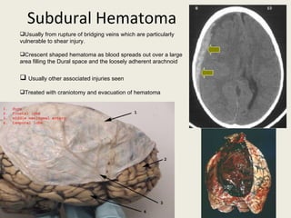 Subdural Hematoma Usually from rupture of bridging veins which are particularly vulnerable to shear injury. Crescent shaped hematoma as blood spreads out over a large area filling the Dural space and the loosely adherent arachnoid Usually other associated injuries seen Treated with craniotomy and evacuation of hematoma 