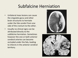 Subfalcine Herniation Unilateral mass lesions can cause the cingulate gyrus and other brain structures to herniate under the falx cerebri from one side of the cranium to the other. Usually no clinical signs can be attributed directly to the subfalcine herniation. Sometimes however the one or both anterior cerebral arteries can become occluded under the falx, leading to infarcts in the anterior cerebral territory. 