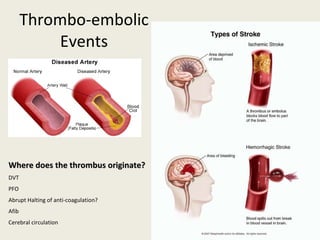Thrombo-embolic Events Where does the thrombus originate? DVT PFO Abrupt Halting of anti-coagulation? Afib Cerebral circulation 