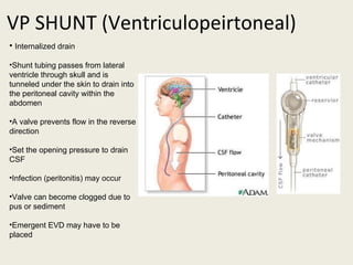 VP SHUNT (Ventriculopeirtoneal) Internalized drain Shunt tubing passes from lateral ventricle through skull and is tunneled under the skin to drain into the peritoneal cavity within the abdomen A valve prevents flow in the reverse direction Set the opening pressure to drain CSF  Infection (peritonitis) may occur Valve can become clogged due to pus or sediment Emergent EVD may have to be placed 