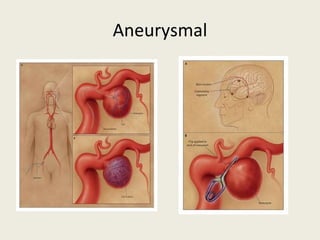 Aneurysmal 