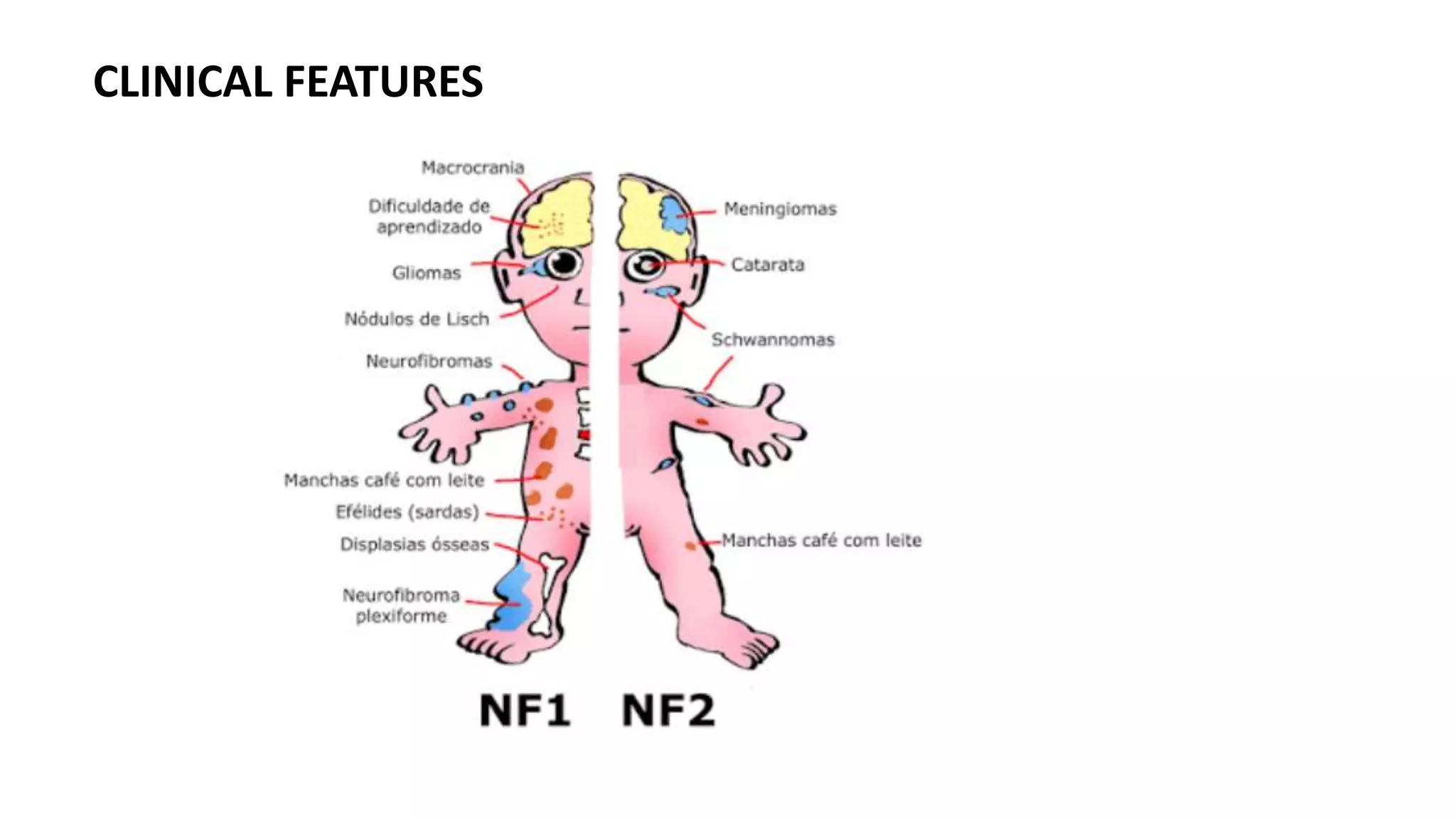 Neurocutaneous marker by dr.Tejas