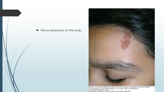 Sebaceous Birthmark Neurocutaneous markers ..by dr shiv kumar saini | PPTX