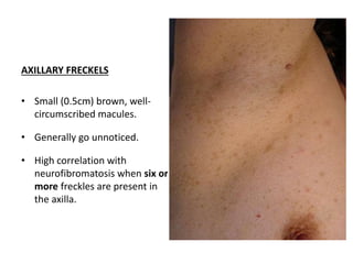 AXILLARY FRECKELS
• Small (0.5cm) brown, well-
circumscribed macules.
• Generally go unnoticed.
• High correlation with
neurofibromatosis when six or
more freckles are present in
the axilla.
 