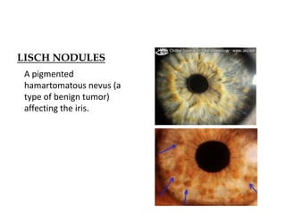 LISCH NODULES
A pigmented
hamartomatous nevus (a
type of benign tumor)
affecting the iris.
 