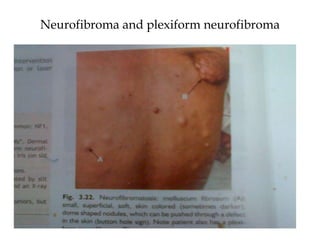 Neurofibroma and plexiform neurofibroma
 