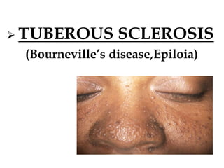  TUBEROUS SCLEROSIS
(Bourneville’s disease,Epiloia)
 