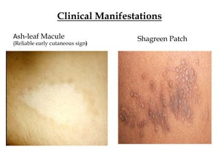 Clinical Manifestations
Ash-leaf Macule
(Reliable early cutaneous sign)
Shagreen Patch
 