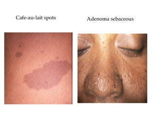Cafe-au-lait spots Adenoma sebaceous
 