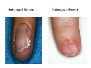 Subungual fibroma Periungual fibroma
 