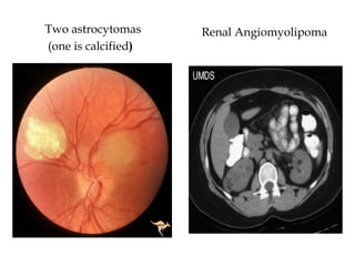 Two astrocytomas
(one is calcified)
Renal Angiomyolipoma
 
