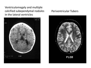 Ventriculomegaly and multiple
calcified subependymal nodules
in the lateral ventricles
Periventricular Tubers
 