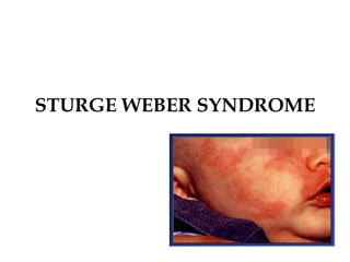STURGE WEBER SYNDROME
 