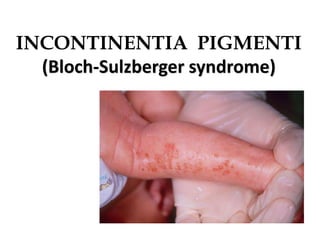 INCONTINENTIA PIGMENTI
(Bloch-Sulzberger syndrome)
 