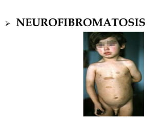  NEUROFIBROMATOSIS
 