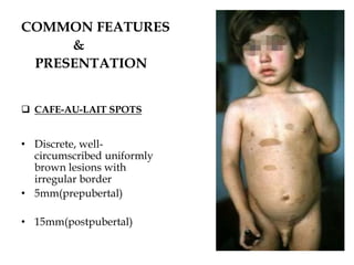 COMMON FEATURES
&
PRESENTATION
 CAFE-AU-LAIT SPOTS
• Discrete, well-
circumscribed uniformly
brown lesions with
irregular border
• 5mm(prepubertal)
• 15mm(postpubertal)
 