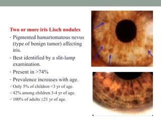 Two or more iris Lisch nodules
• Pigmented hamartomatous nevus
(type of benign tumor) affecting
iris.
• Best identified by a slit-lamp
examination.
• Present in >74%
• Prevalence increases with age.
Only 5% of children <3 yr of age.
42% among children 3-4 yr of age.
100% of adults ≥21 yr of age.
 