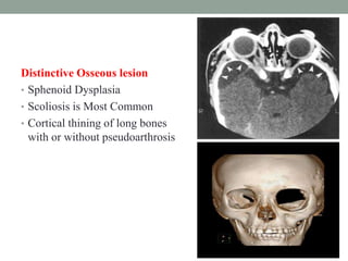 Distinctive Osseous lesion
• Sphenoid Dysplasia
• Scoliosis is Most Common
• Cortical thining of long bones
with or without pseudoarthrosis
 