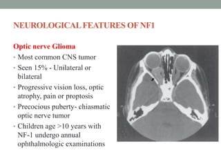 NEUROLOGICALFEATURES OFNF1
Optic nerve Glioma
• Most common CNS tumor
• Seen 15% - Unilateral or
bilateral
• Progressive vision loss, optic
atrophy, pain or proptosis
• Precocious puberty- chiasmatic
optic nerve tumor
• Children age >10 years with
NF-1 undergo annual
ophthalmologic examinations
 