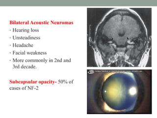 Bilateral Acoustic Neuromas
• Hearing loss
• Unsteadiness
• Headache
• Facial weakness
• More commonly in 2nd and
3rd decade.
Subcapsular opacity- 50% of
cases of NF-2
 