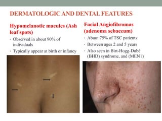 DERMATOLOGICAND DENTALFEATURES
Hypomelanotic macules (Ash
leaf spots)
• Observed in about 90% of
individuals
• Typically appear at birth or infancy
Facial Angiofibromas
(adenoma sebaceum)
• About 75% of TSC patients
• Between ages 2 and 5 years
• Also seen in Birt-Hogg-Dubé
(BHD) syndrome, and (MEN1)
 